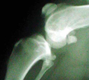 Glucozamina in tratamentul osteoartritei – exista beneficii dovedite? - Revista Galenus